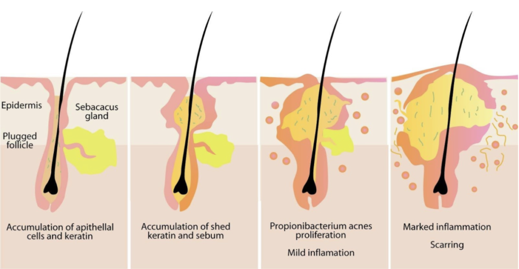 Acne Facial - Skinspire Laser&Skin Clinic