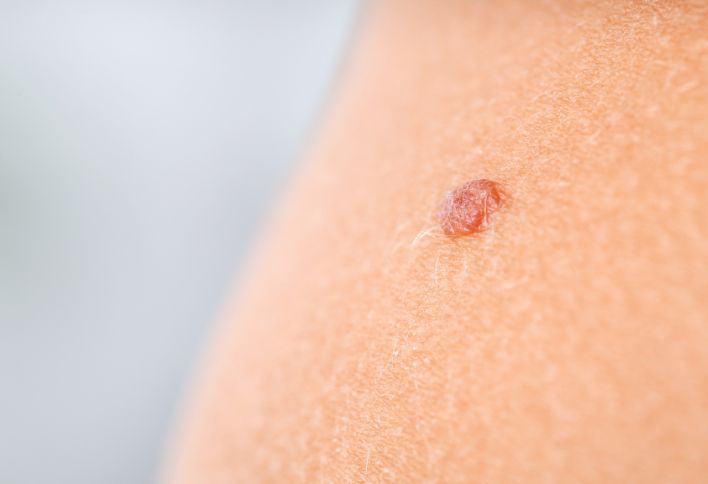 Mole - Skinspire Laser&Skin Clinic